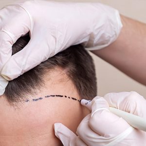 Hair Transplant Deposit Payment